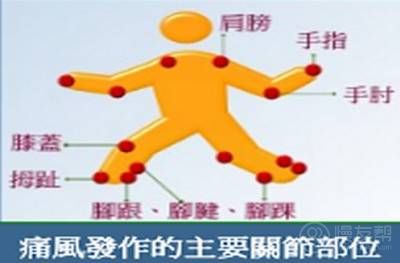 痛风发作的主要关节部位(图)
