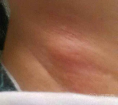 腋下长了个小疙瘩,度娘有好几种说法