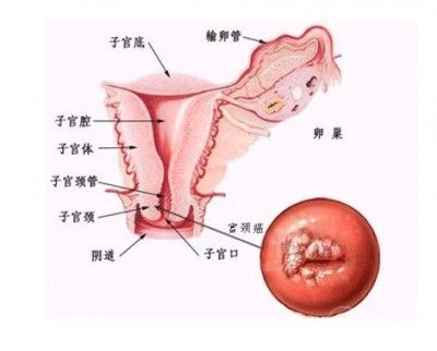 震惊宫颈糜烂其实不是病