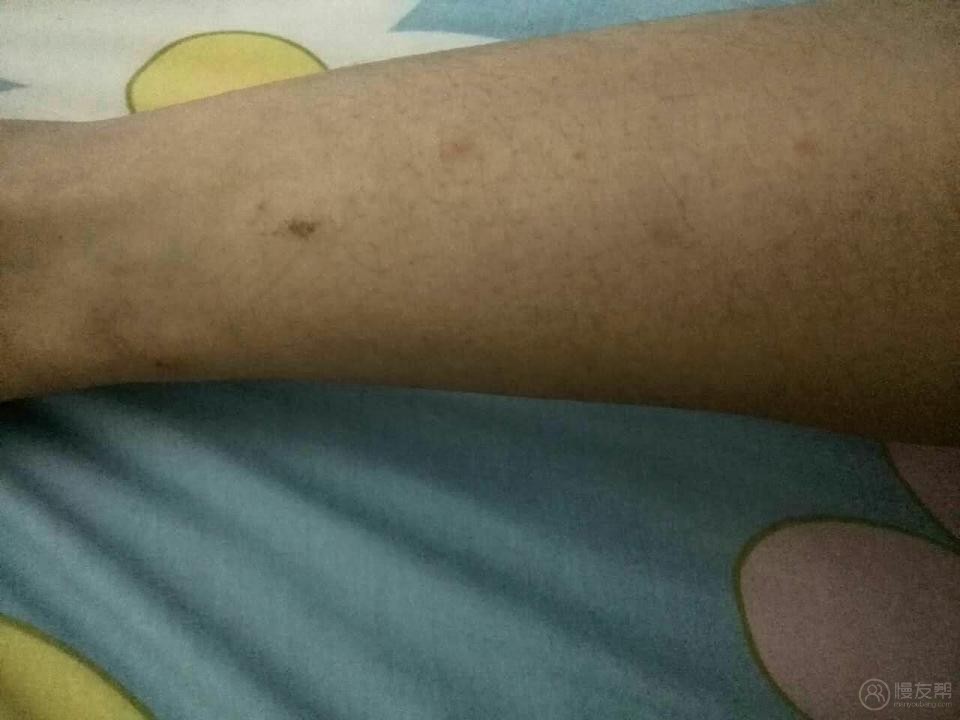 季节性湿疹求求治方- 慢友帮-慢病病友互帮社区