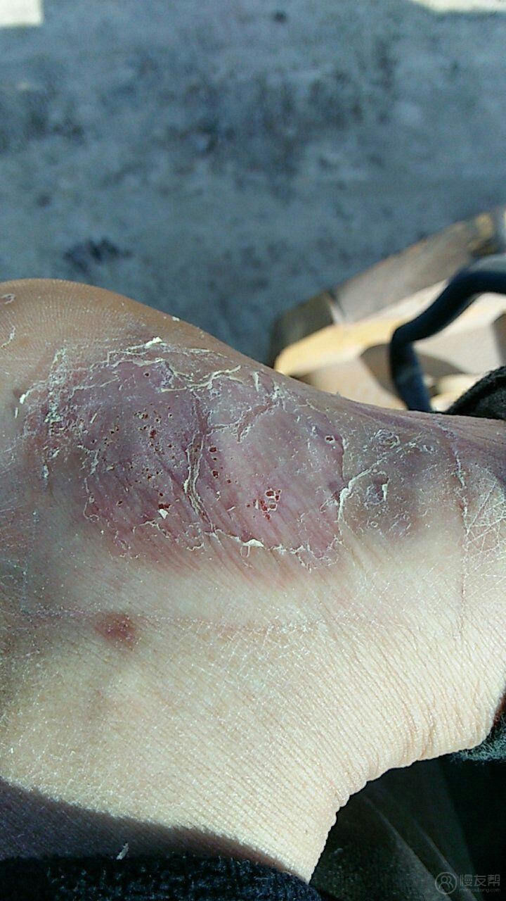 请问这种是什么皮肤病,脚上,手上的有