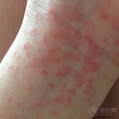 好多汗 打羽毛球 然后晚上就起来了 手臂 还有膝盖内侧 我妈说是痱子