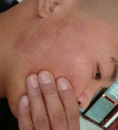 我也不知道自己脸上这个是什么.