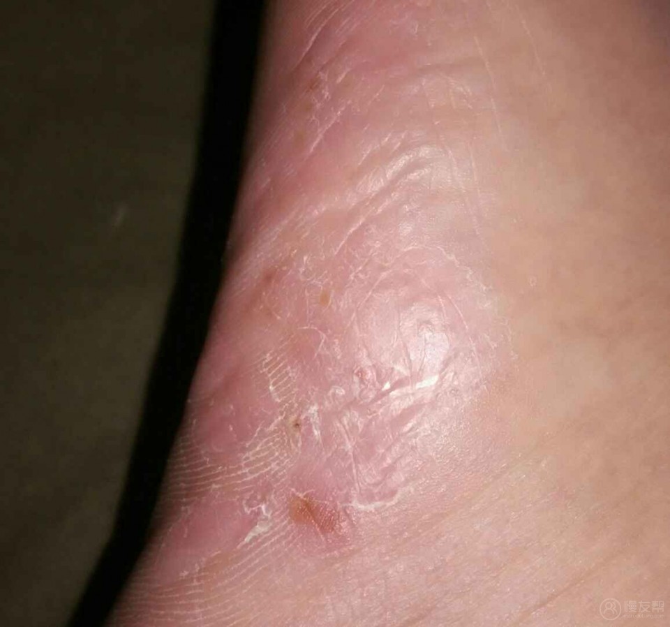 真菌脚气症状图片图片