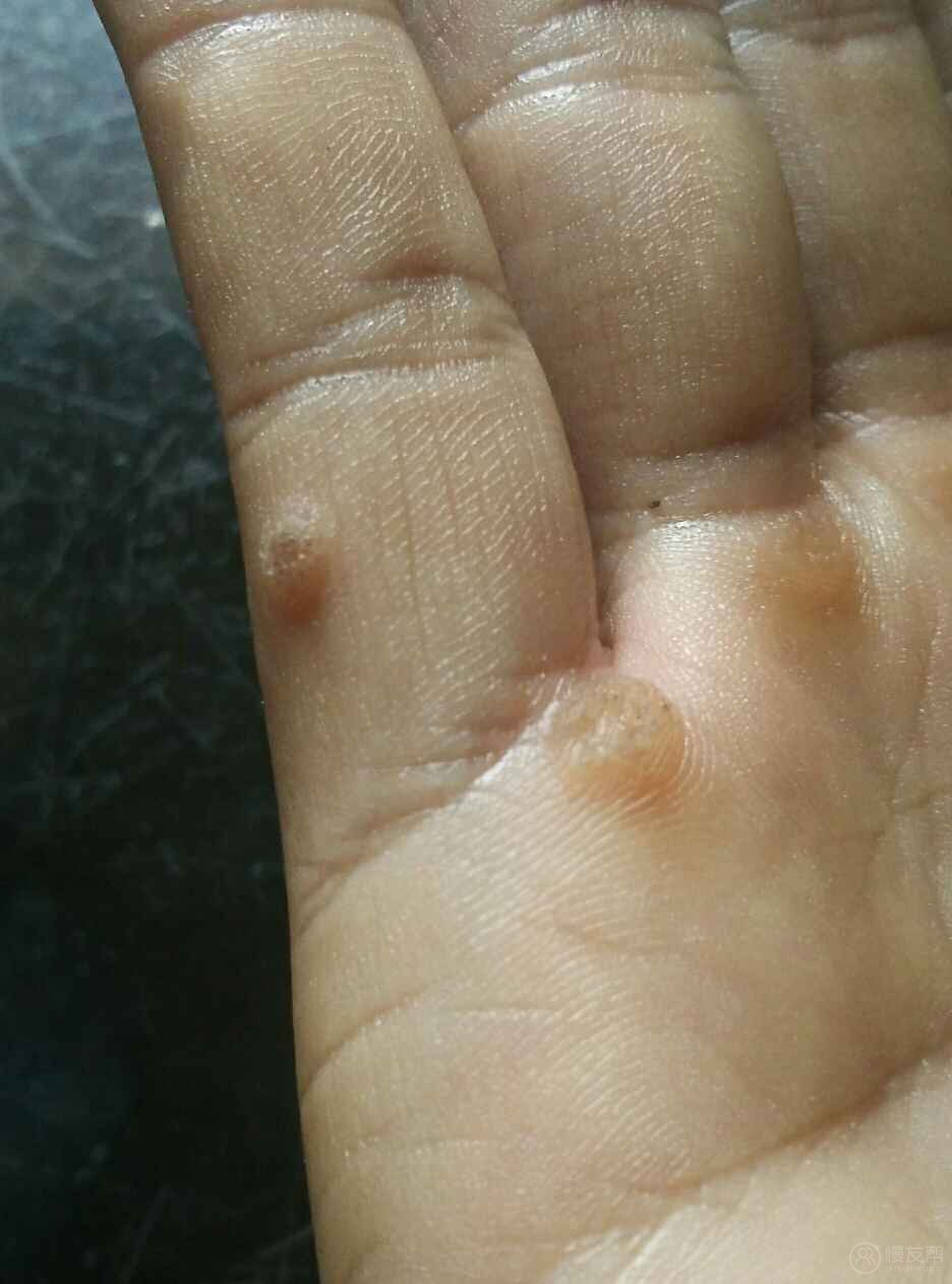 这是什么皮肤病