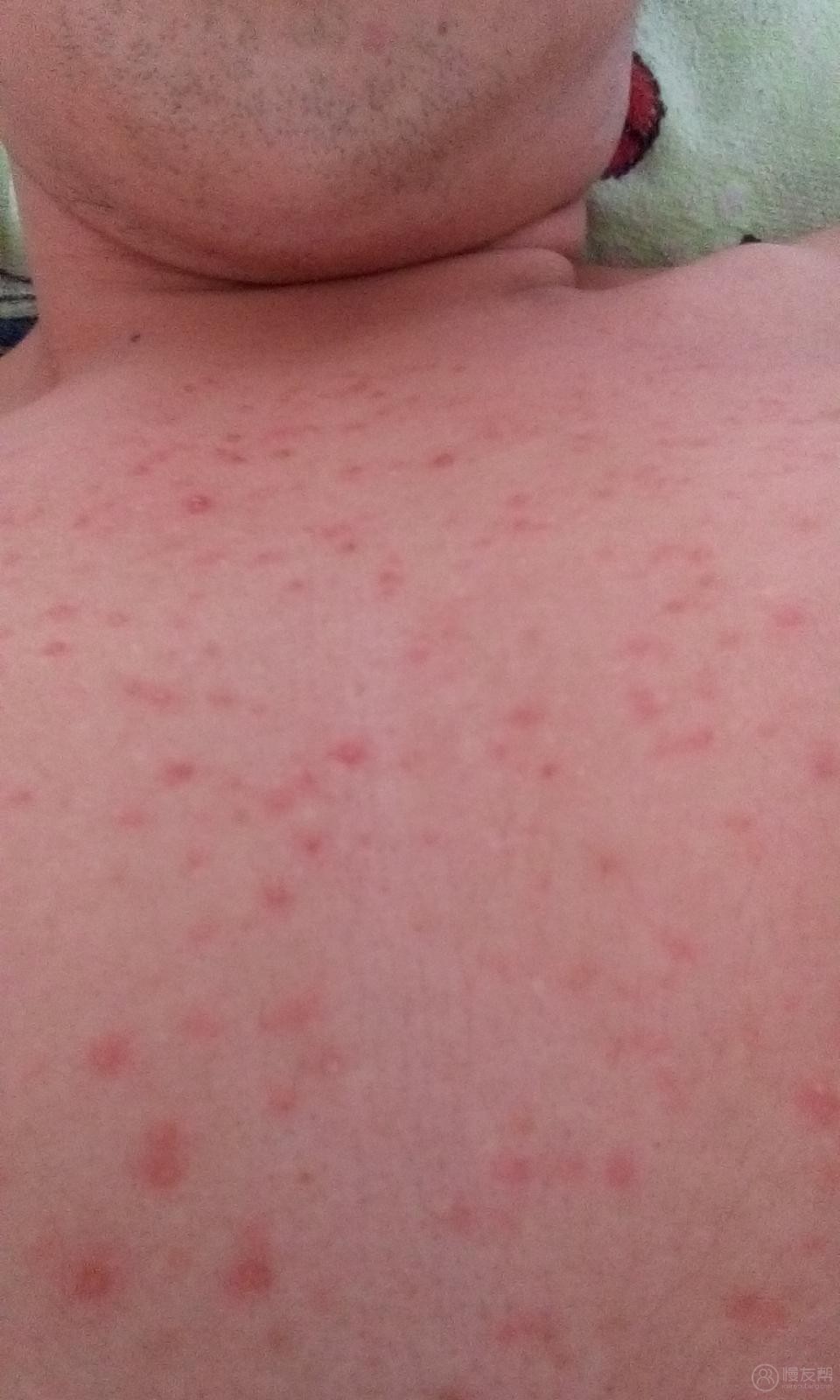 胸口长了一大片痘痘- 慢友帮—慢病病友互帮社区