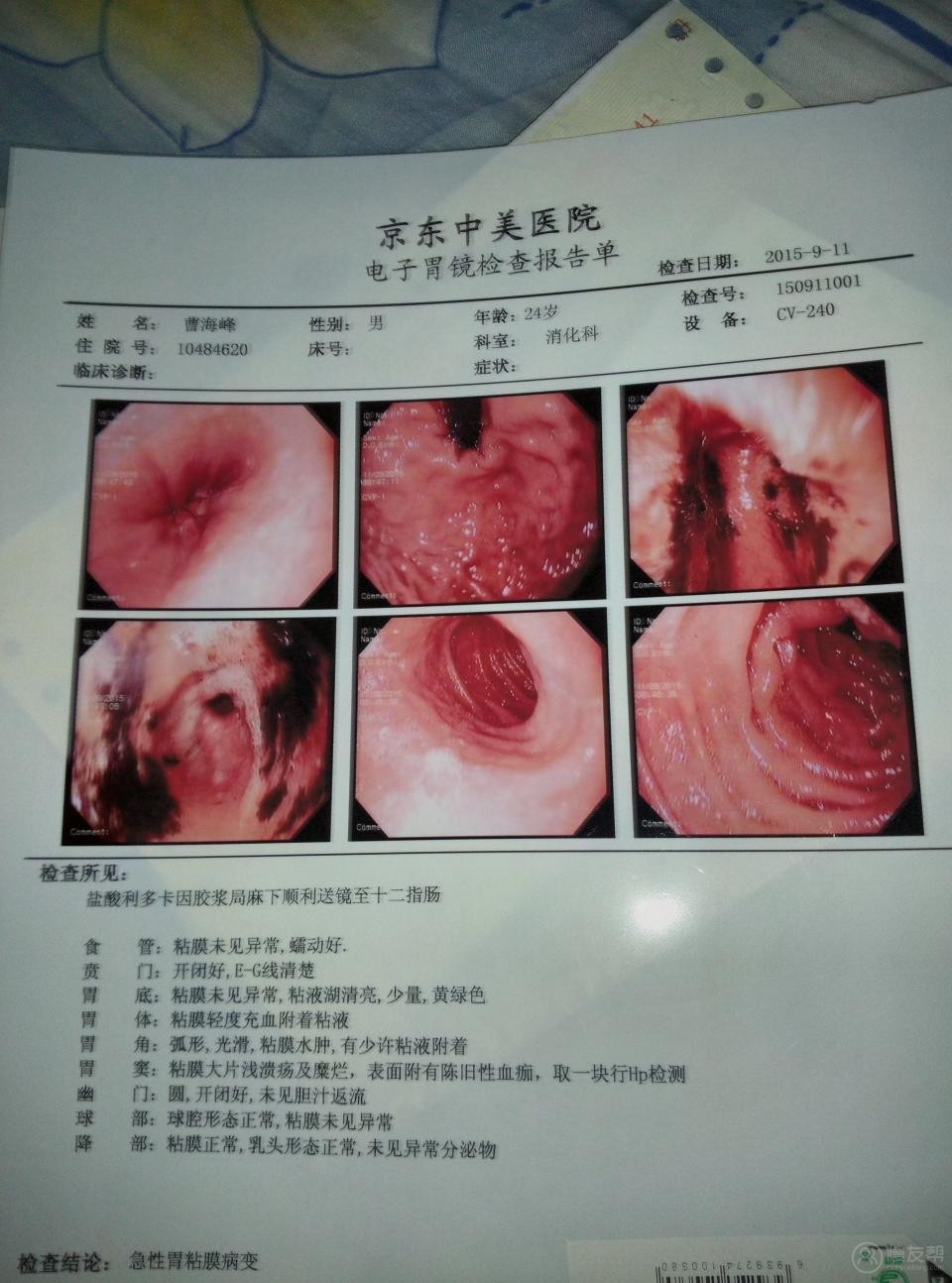 球体,降部都正常活体取样试验为hp)胃窦:粘膜大片浅溃疡及糜烂
