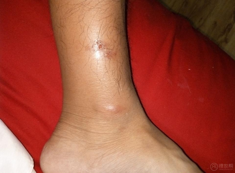 腿上起红疙瘩还出水