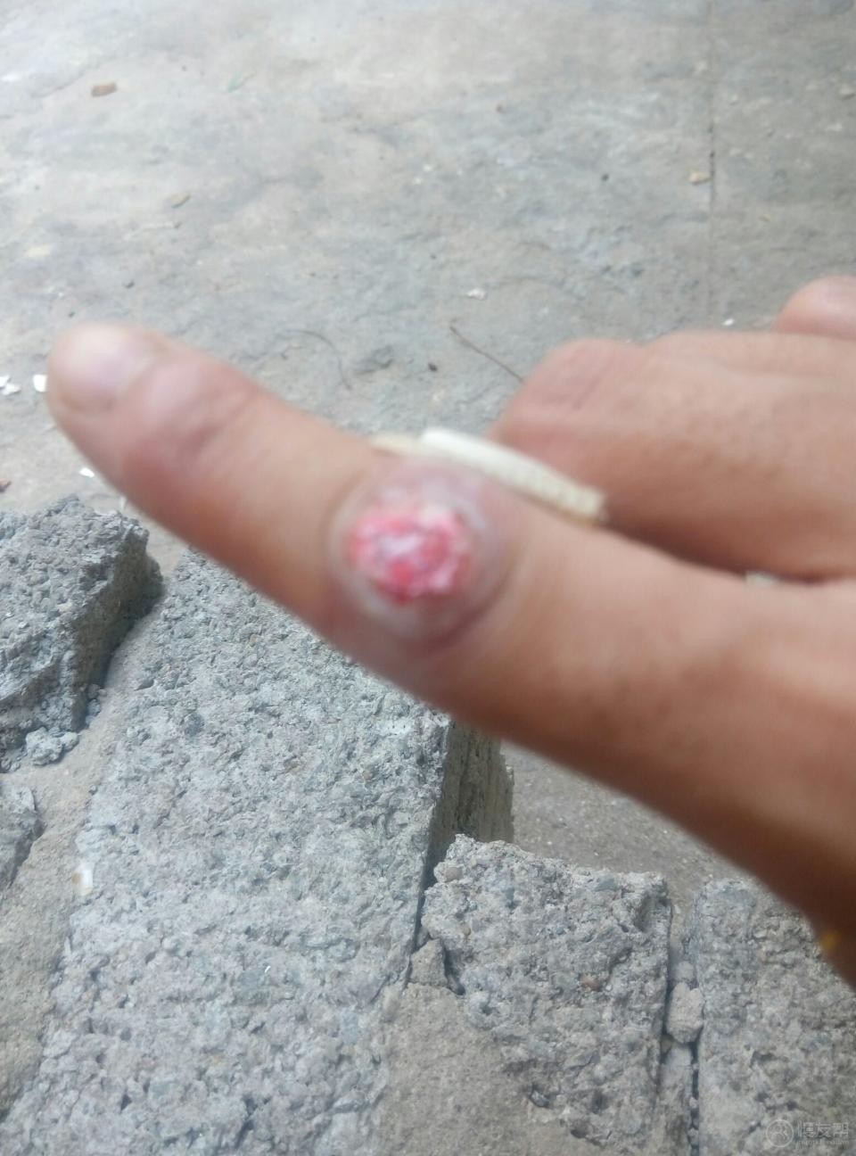 我手上长了3个瘊子,有5个多月了.怎么治都没有好,现在用鸡眼膏贴.