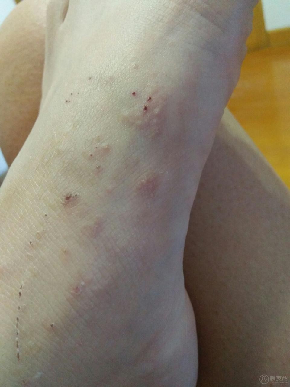 手脚老是反复长白色疙瘩特别痒