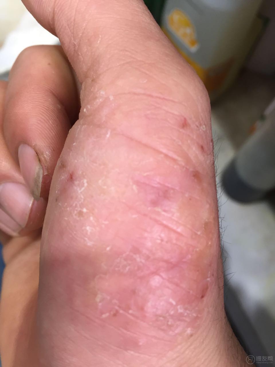 手痒还有水泡用什么药