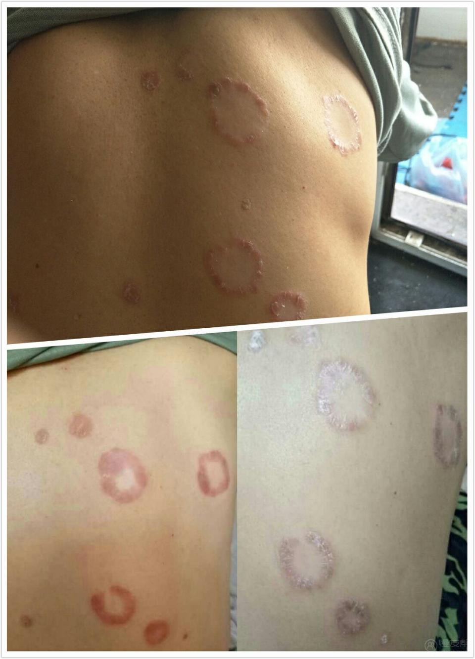 是一种由禽类血吸虫尾坳钻入皮肤引起尾坳皮炎